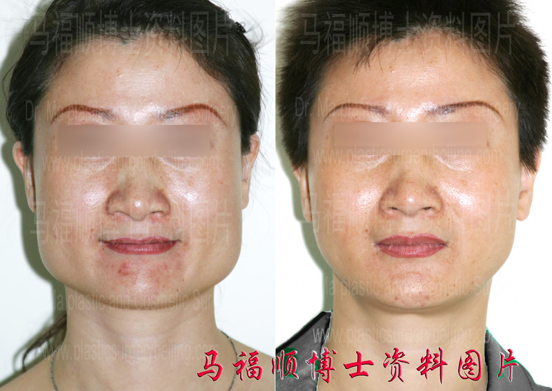Square Face Reduction Surgery