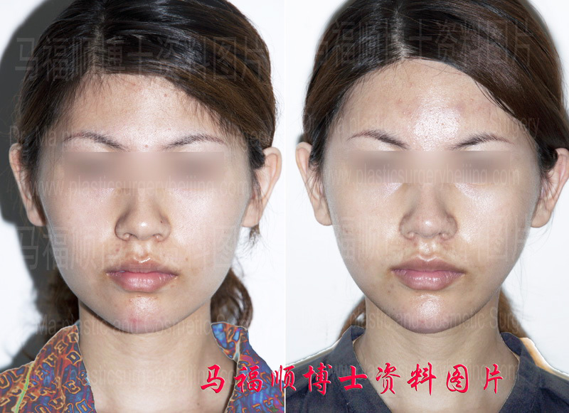 Zygomatic Arch and Malar Reduction