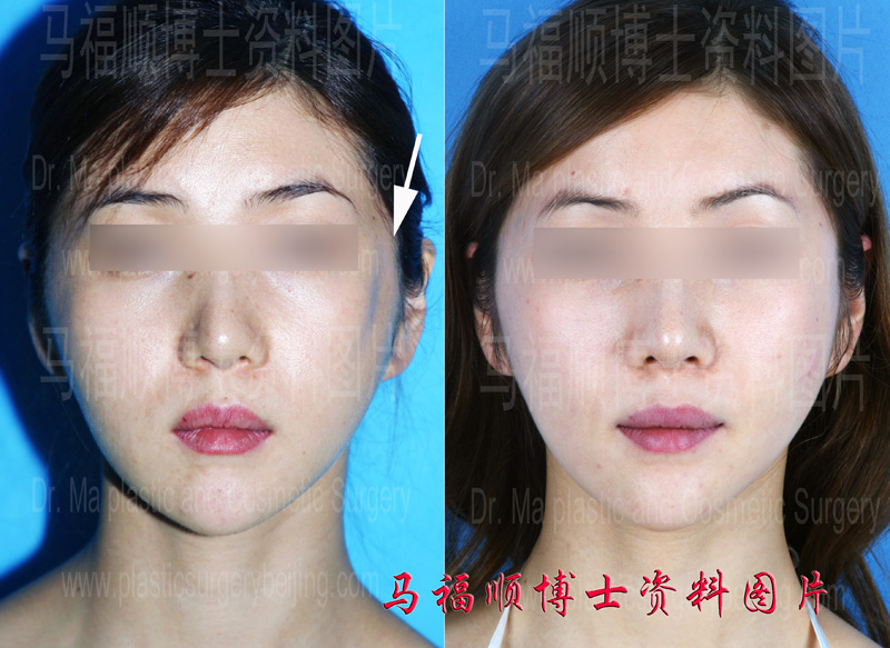 Restoration of Facial Sagginess and Indentation After Zyogmatic Bone and Zygomatic Arch Surgery