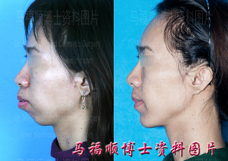 Surgical Correction of Bimaxillary Protrusion with Micrognathia