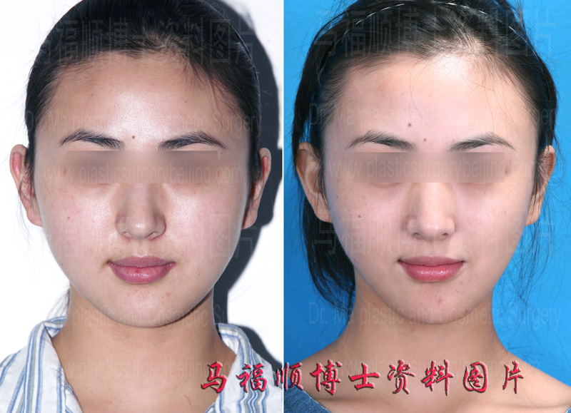 V Shape Face Achieved by Cheek Bone Reduction Surgery