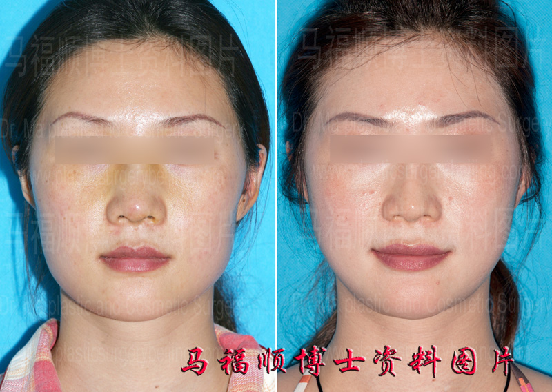 Plastic Surgery Changing Asymmetric Square Face to Symmetric Oval One