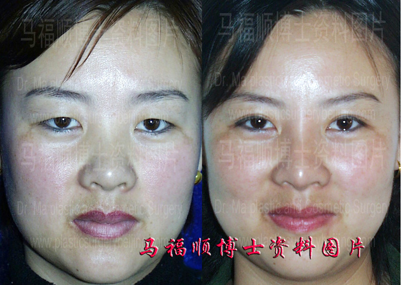 Augmentation Rhinoplasty and Blepharoplasty