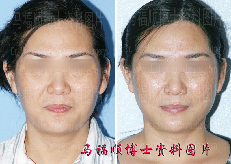 Cheekbone Reduction Surgery