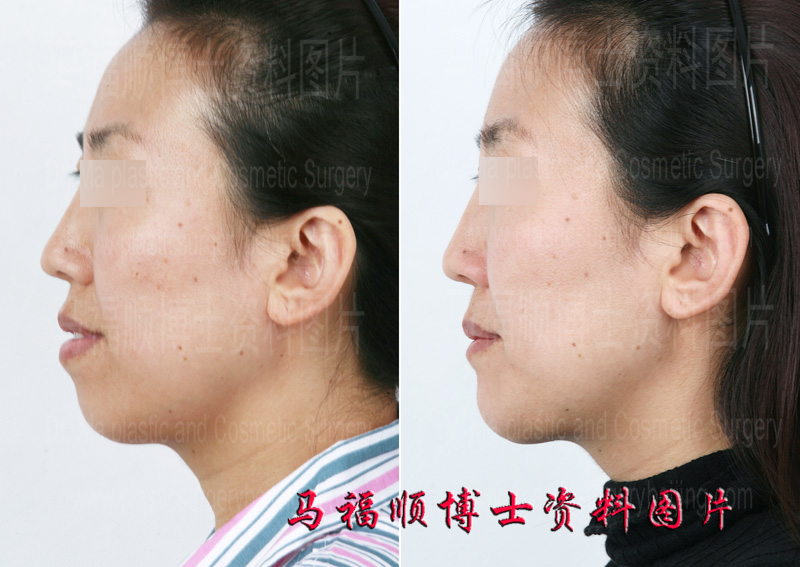 Protrusion Mouth Correction Surgery