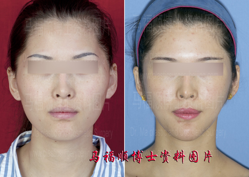 Mandible Bone and Masseter Muscle Reduction to Achieve a Melon Seed Face
