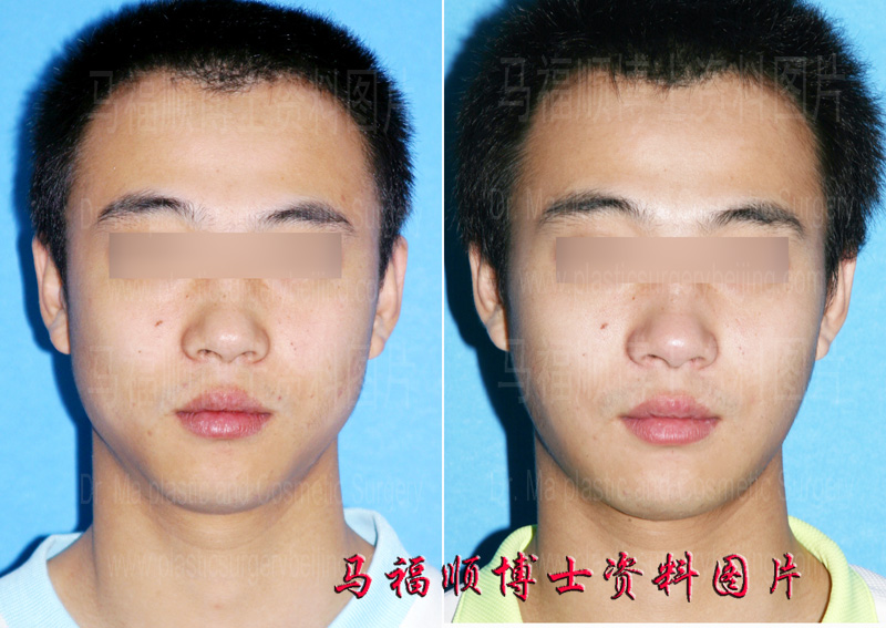 Square Face Reshaping with Massseter Muscle and Buccal Fat Partial Removal