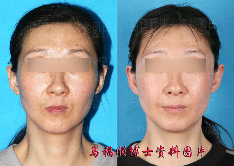 Feathering Reduction Malar Plasty