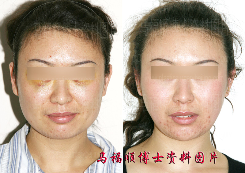 Transforming a Square Face to Oval with Mandible Angle and Masseter Muscle Reduction