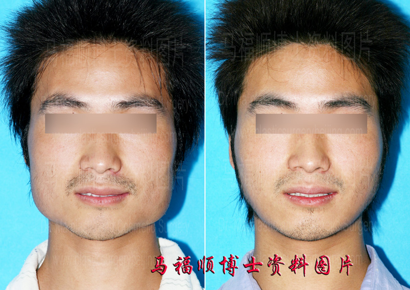 Mandible Bone and Mandible Angle Reduction for Male