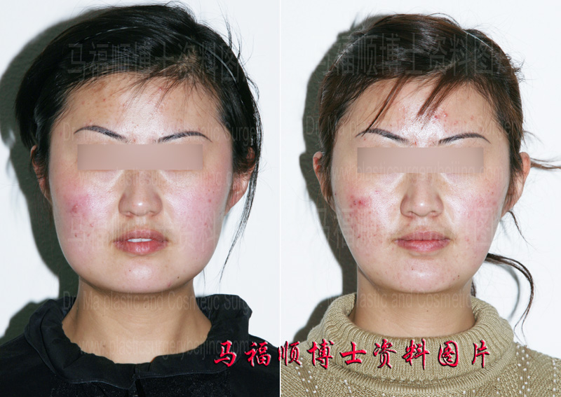 Zygoma and Zygomatic Arch Reduction for a Slimmer Face