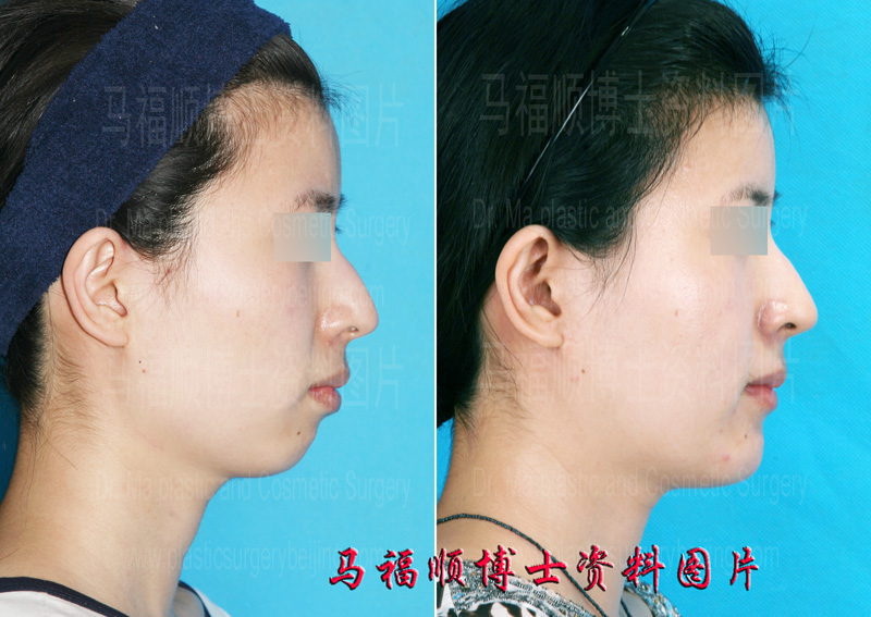 Retrograded Chin Forward Sliding Surgery