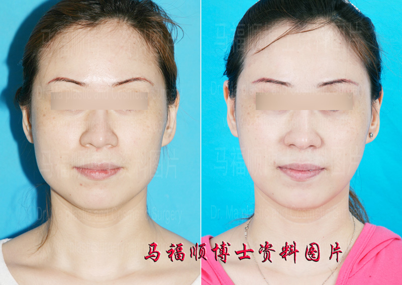 Plastic Surgery Changing Square Face to Oval Shape