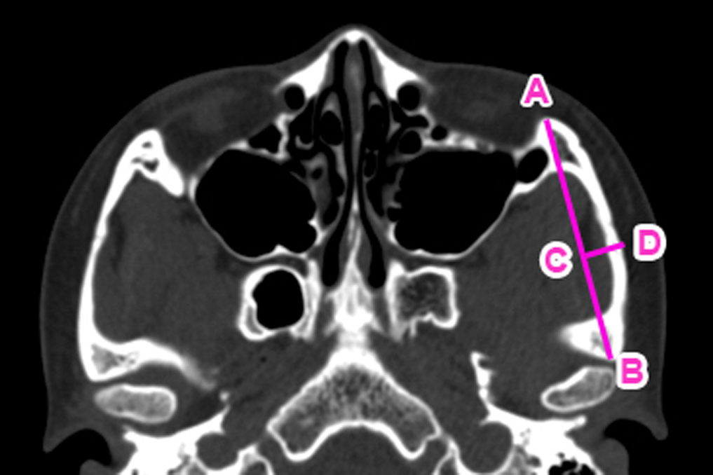 Zygomatic Arch Reduction and Malarplasty with Multiple Osteotomies: Its Geometric Considerations