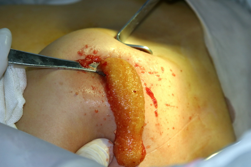 Injectable Removal After Polyacrylamide Injection Brest Augmentation