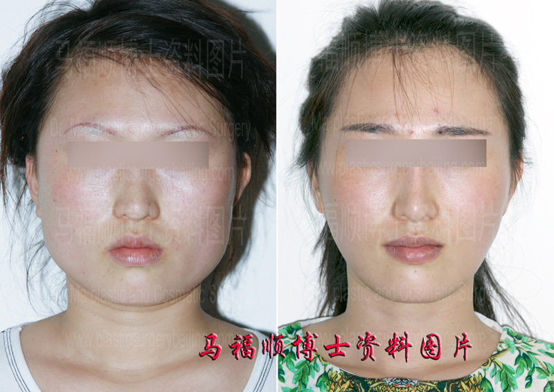 Trimming the Face in Stages