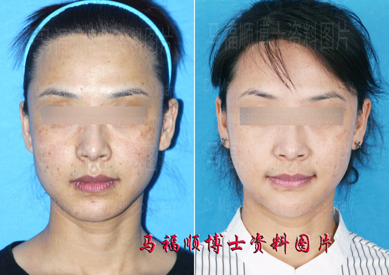 Combined Chin and Jaw Plastic Surgery