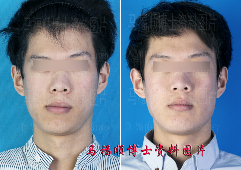 Deviation Facial Deformity Surgical Correction