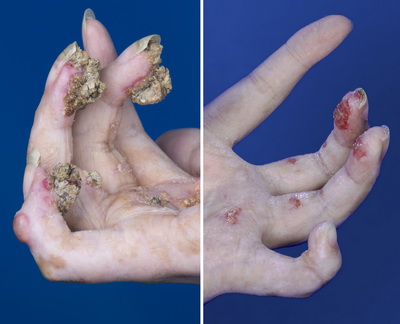 Accumulative eschar after burn