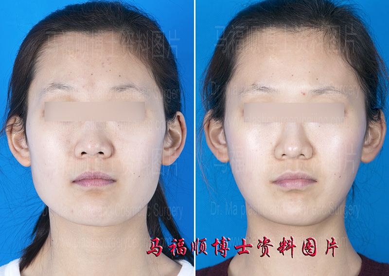 Mandible Reduction Reserving the Landmark of Mandible Angle