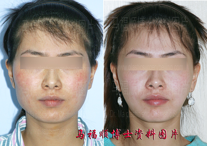 Changing the Big Face to a Slimmer One with Soft Tissue Removal and Facial Bone Reduction