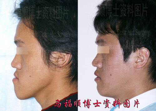 Bright Smile after Underbite Correction Surgery