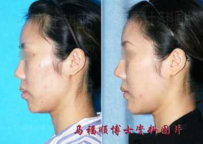Chin Advancement after Polytetrafluoroethylene implant chin augmentation
