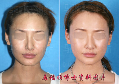 Cheekbone and zygomatic arch reshaping can help create a softer facial shape.